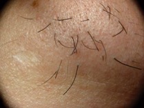 Hair removal on chin