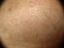 laser hair removal canberra