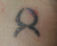 safe tattoo removal