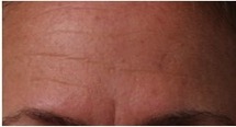 collagen induction