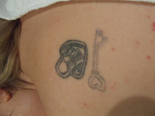 Tattoo removal Tattoo removal